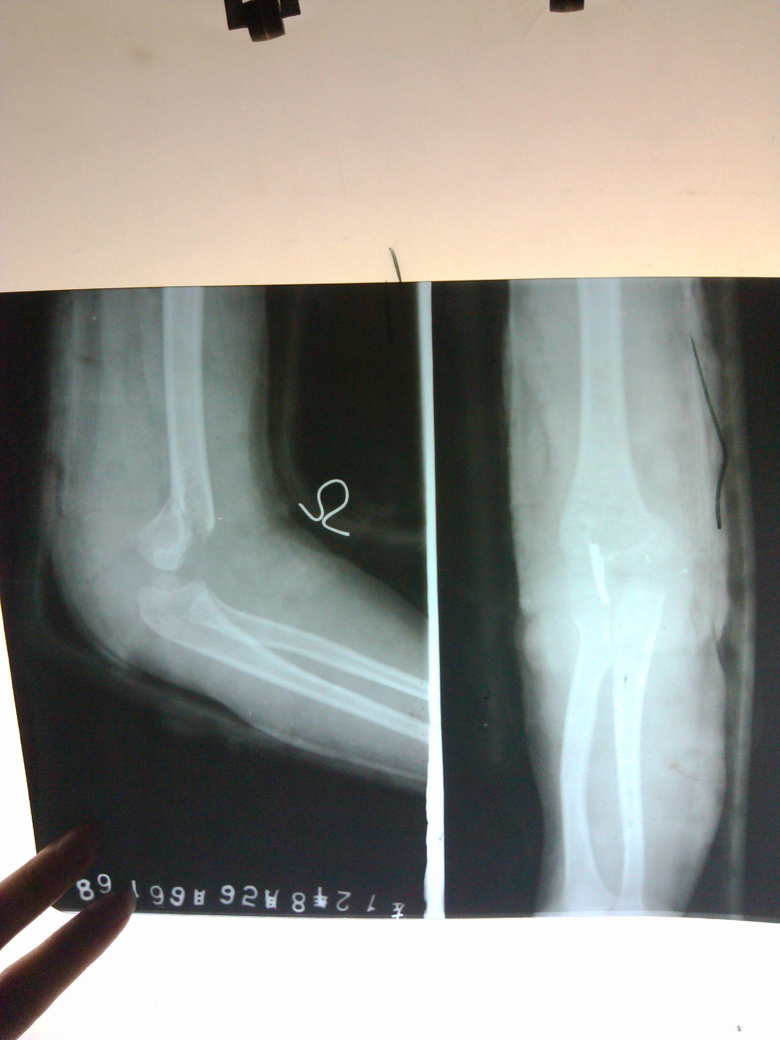 4岁8个月小儿,左肱骨髁上骨折(27号重新到三甲医院复查x光,决定手术