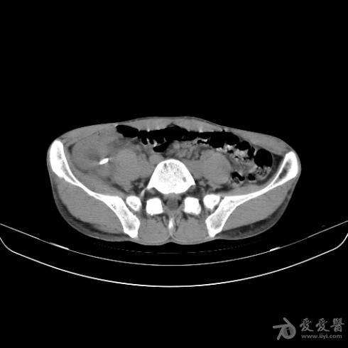 阑尾周围脓肿粪石