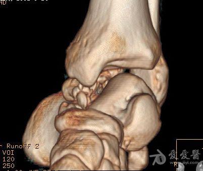 距骨骨折伴踝關節半脫位診斷處理