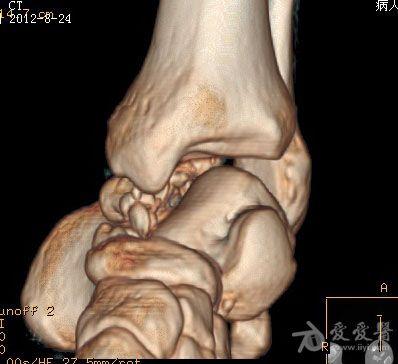 距骨骨折伴踝关节半脱位诊断处理