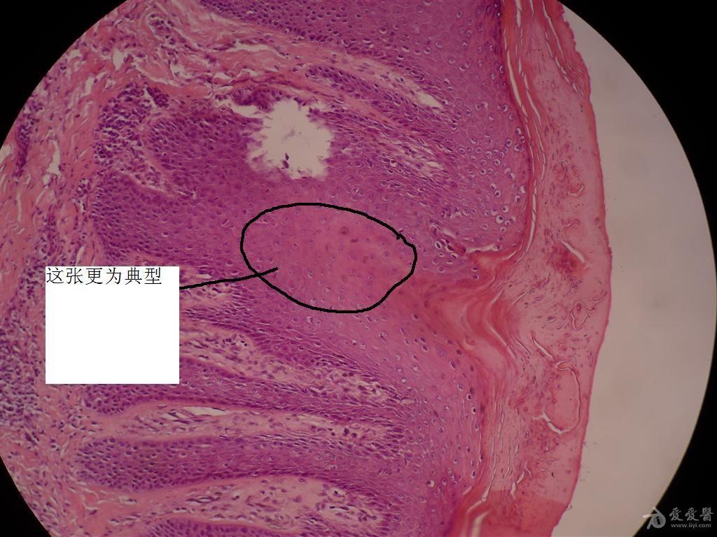 看图诊断答案已给出汗孔角化症