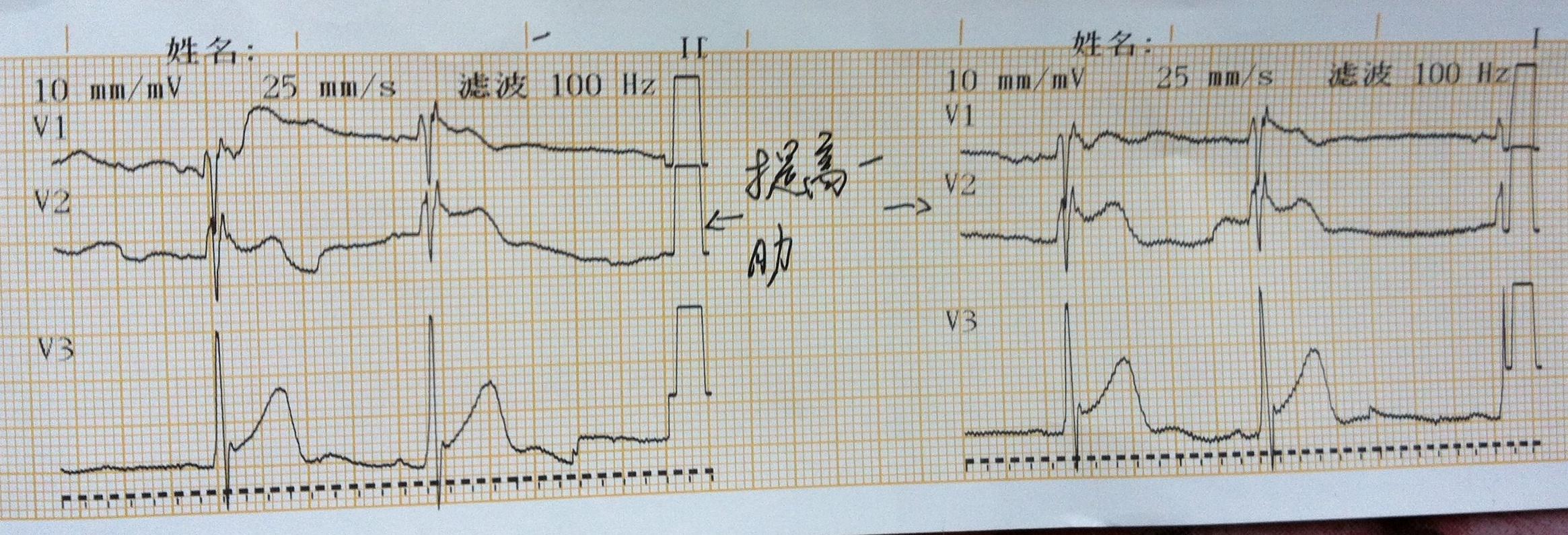 論壇 69 ★臨床檢查區 69 心電圖腦電圖專業討論版 69 竇性心律