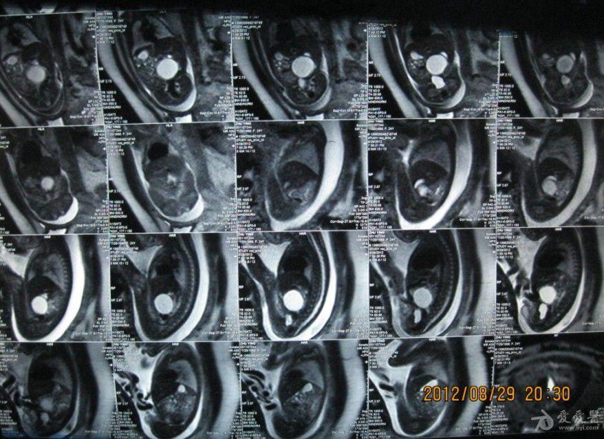 急求磁共振專家胎兒是囊腫還是瘤急求