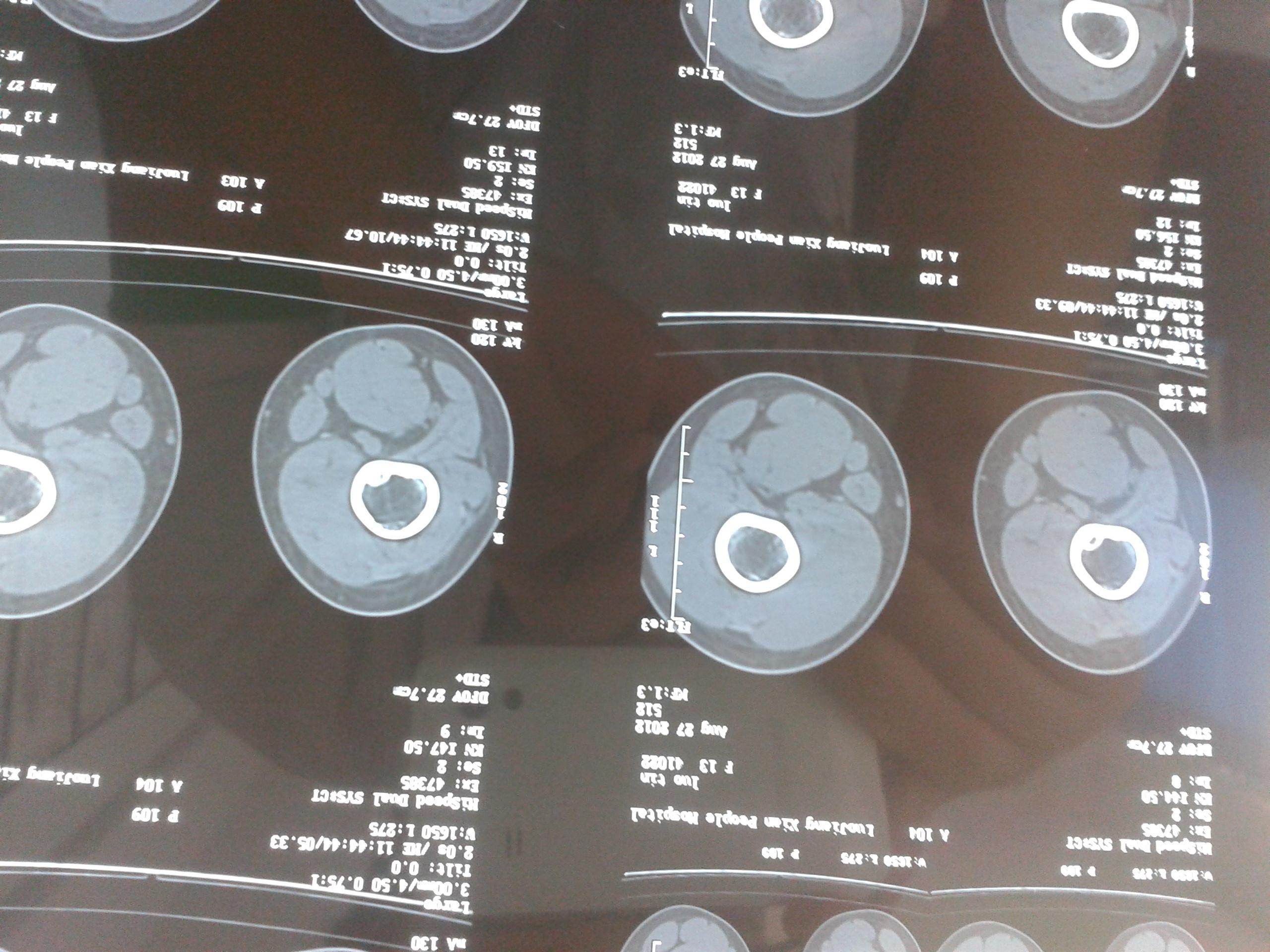 【原创病例】因"右大腿下段疼痛3 月"入院