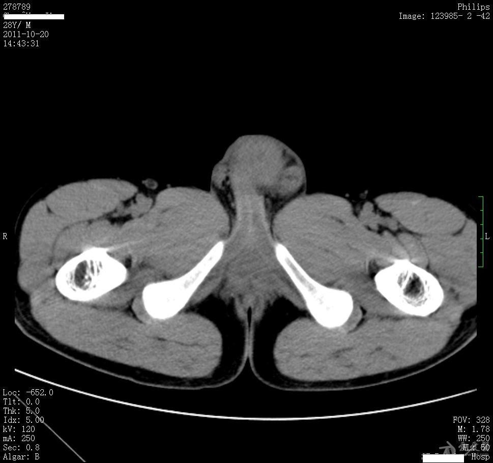 病例15睾丸肿大5月余结果在6楼