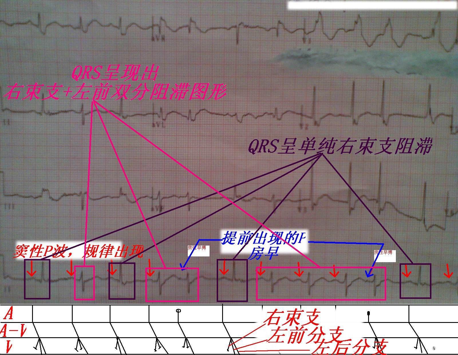 討論其長ii的qrs波為什麼會出現這種情況 - 心電圖腦電圖專業討論版