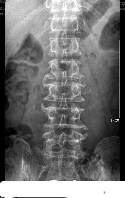 腰椎压缩三分之一图片图片