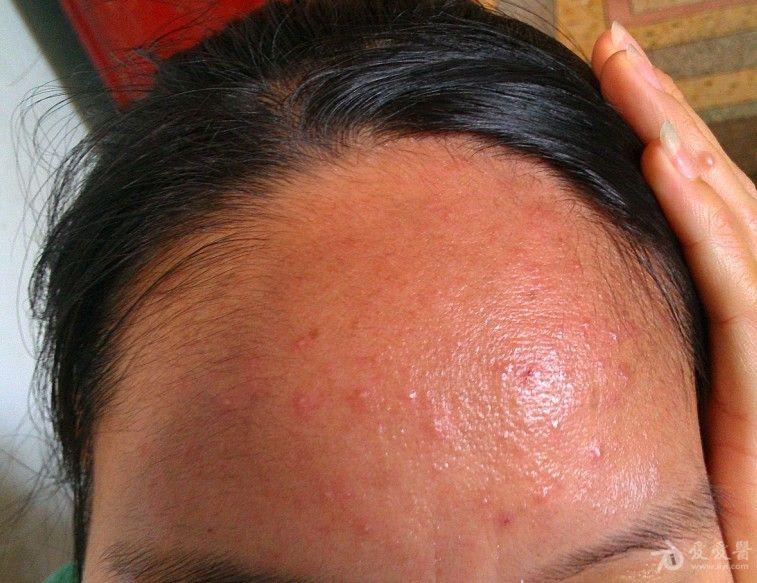 马拉色菌毛囊炎