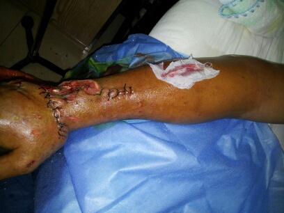 手背皮肤缺损股前外侧皮瓣游离移植一例