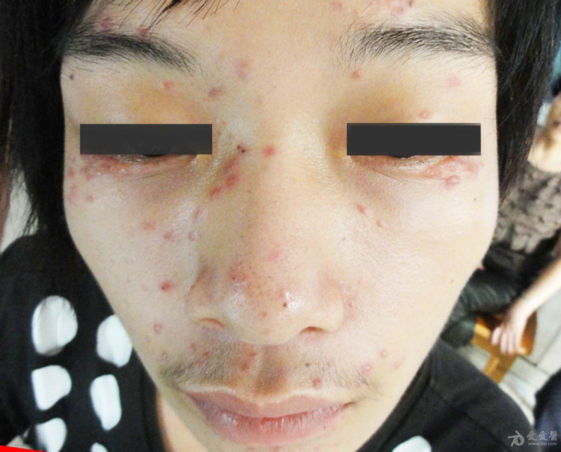 看图诊病颜面播散性粟粒性狼疮