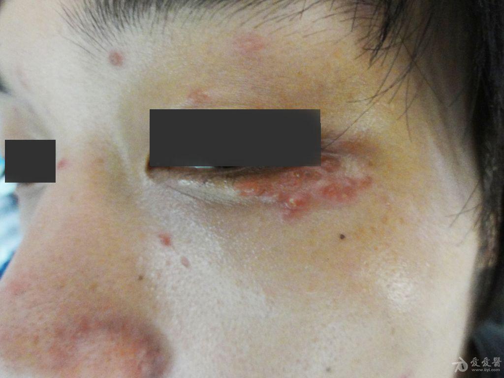 看图诊病颜面播散性粟粒性狼疮