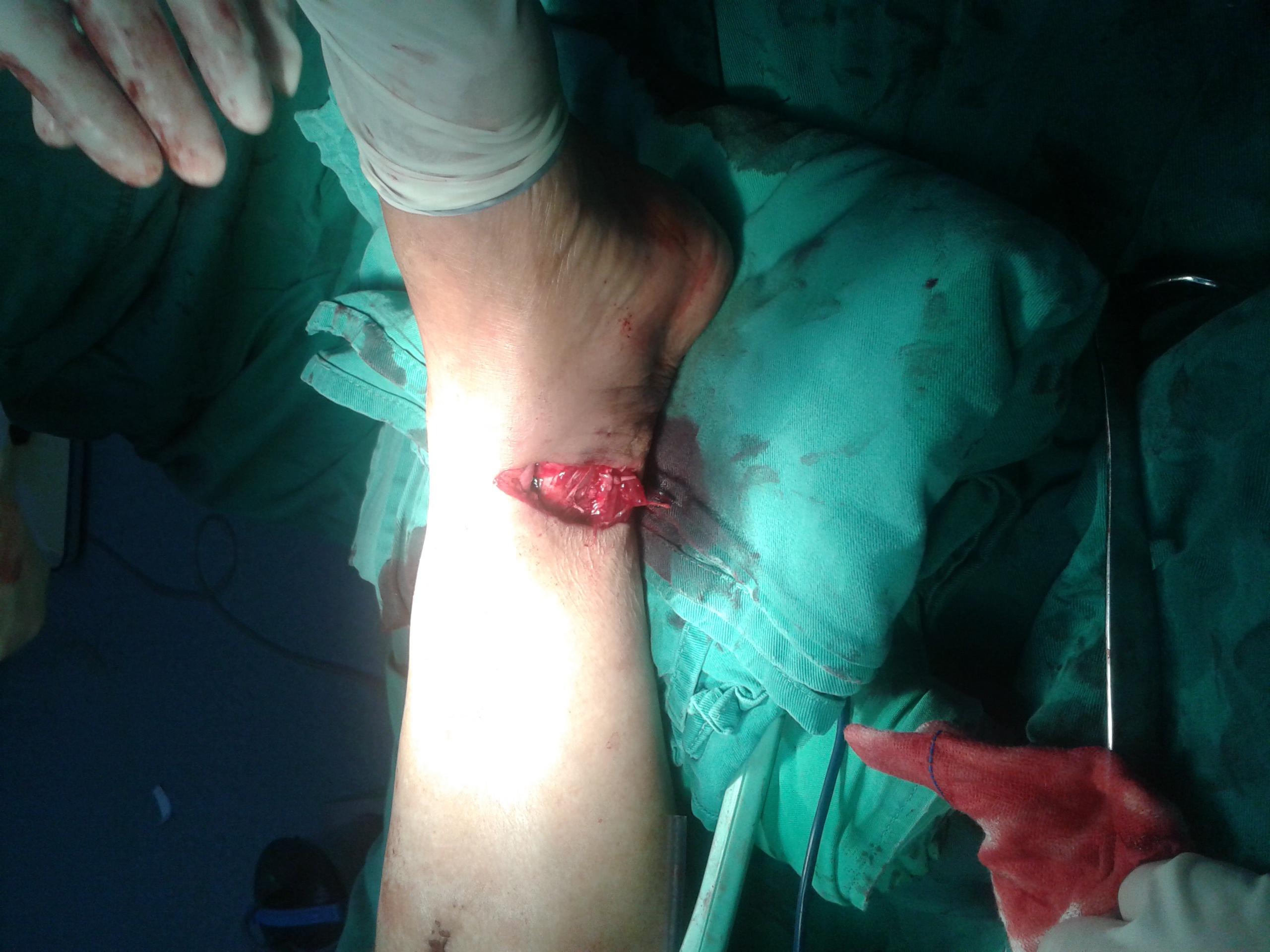 原创病例扭跌伤左踝后疼痛出血畸形1小时