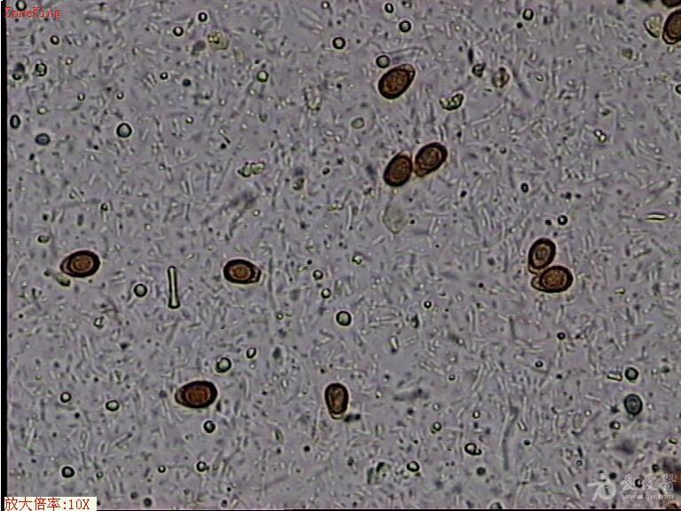 粪便中容易被误认为华支睾吸虫卵的灵芝孢子