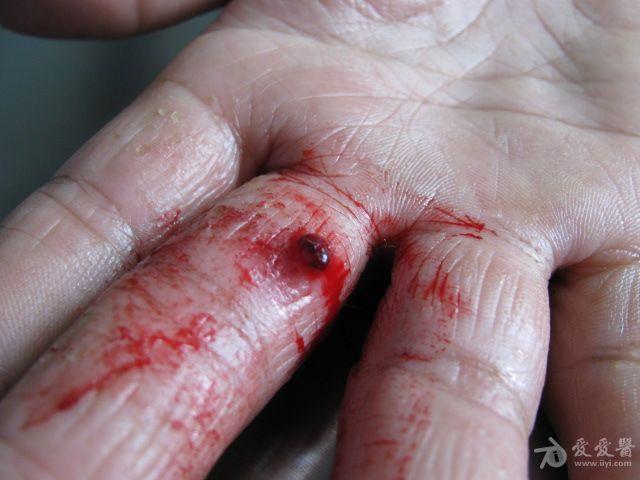 易出血的手化脓性肉芽肿
