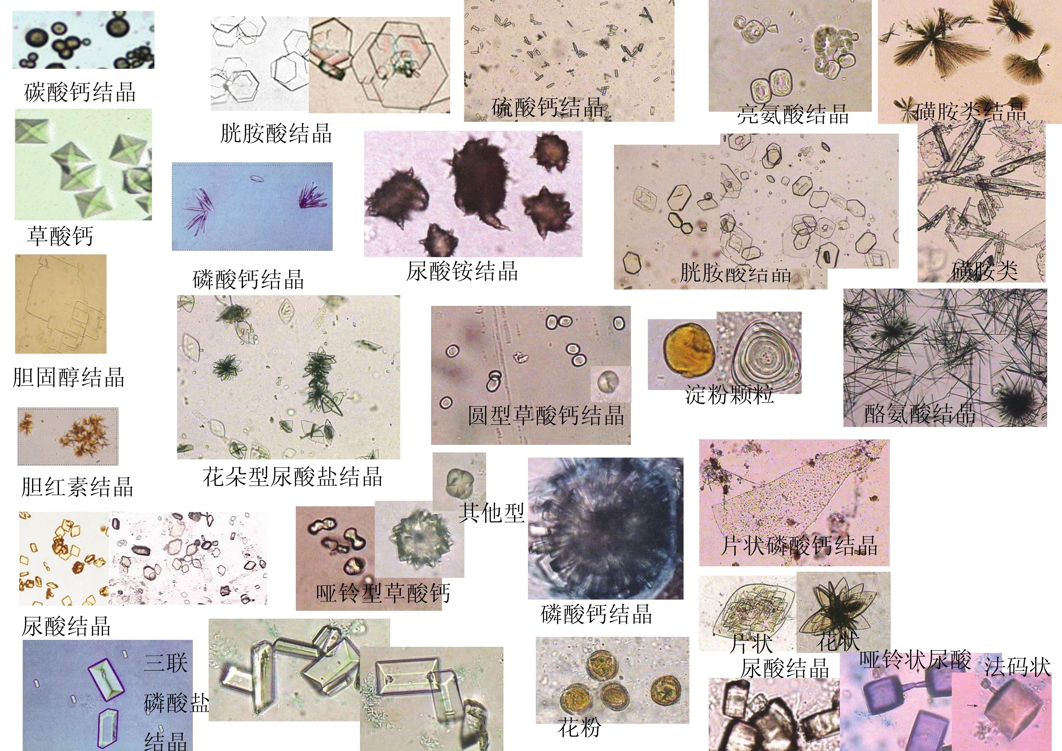 尿酸结晶图谱图片
