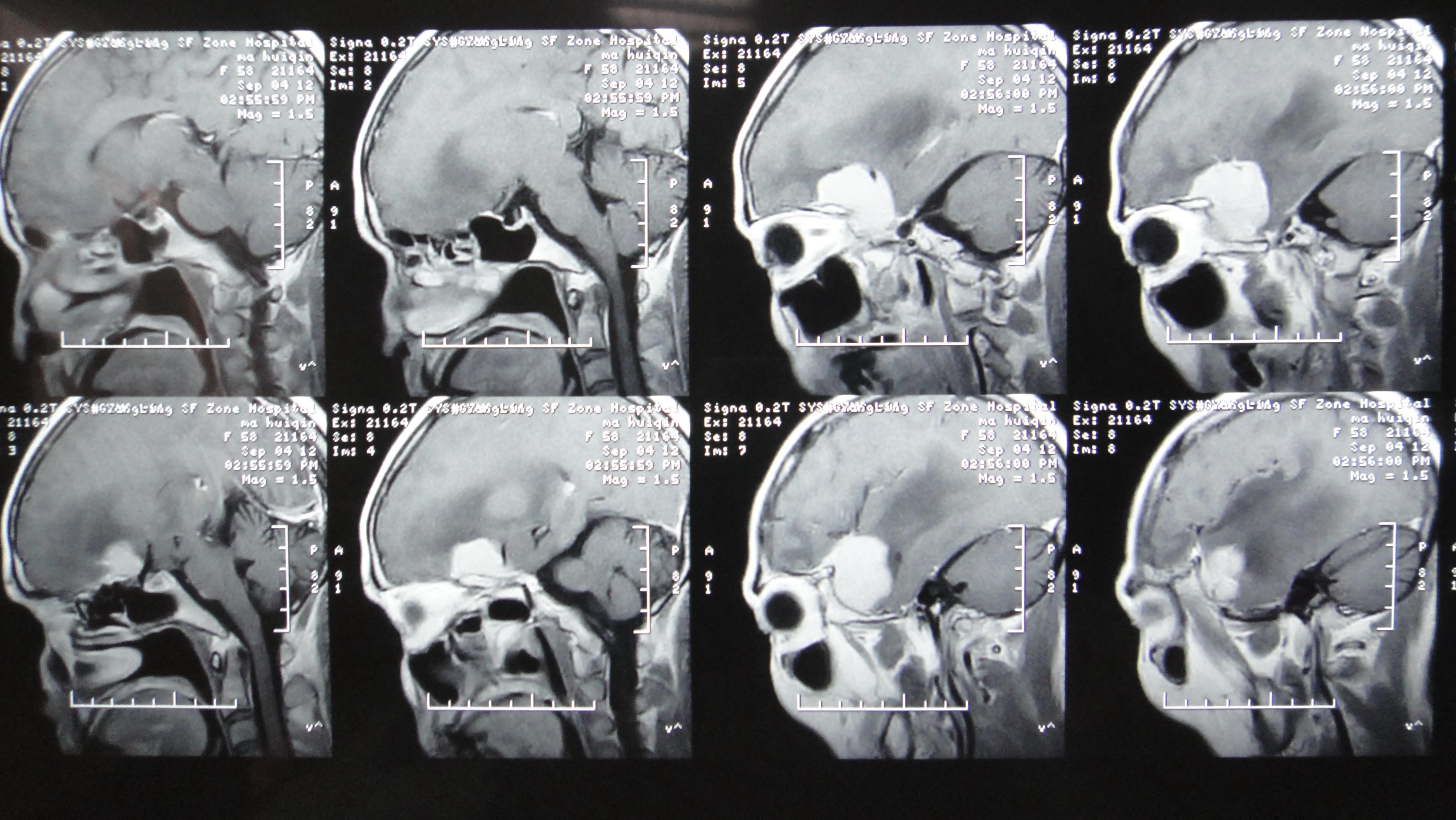 一例很纠结的蝶骨嵴脑膜瘤病例手术风险大吗