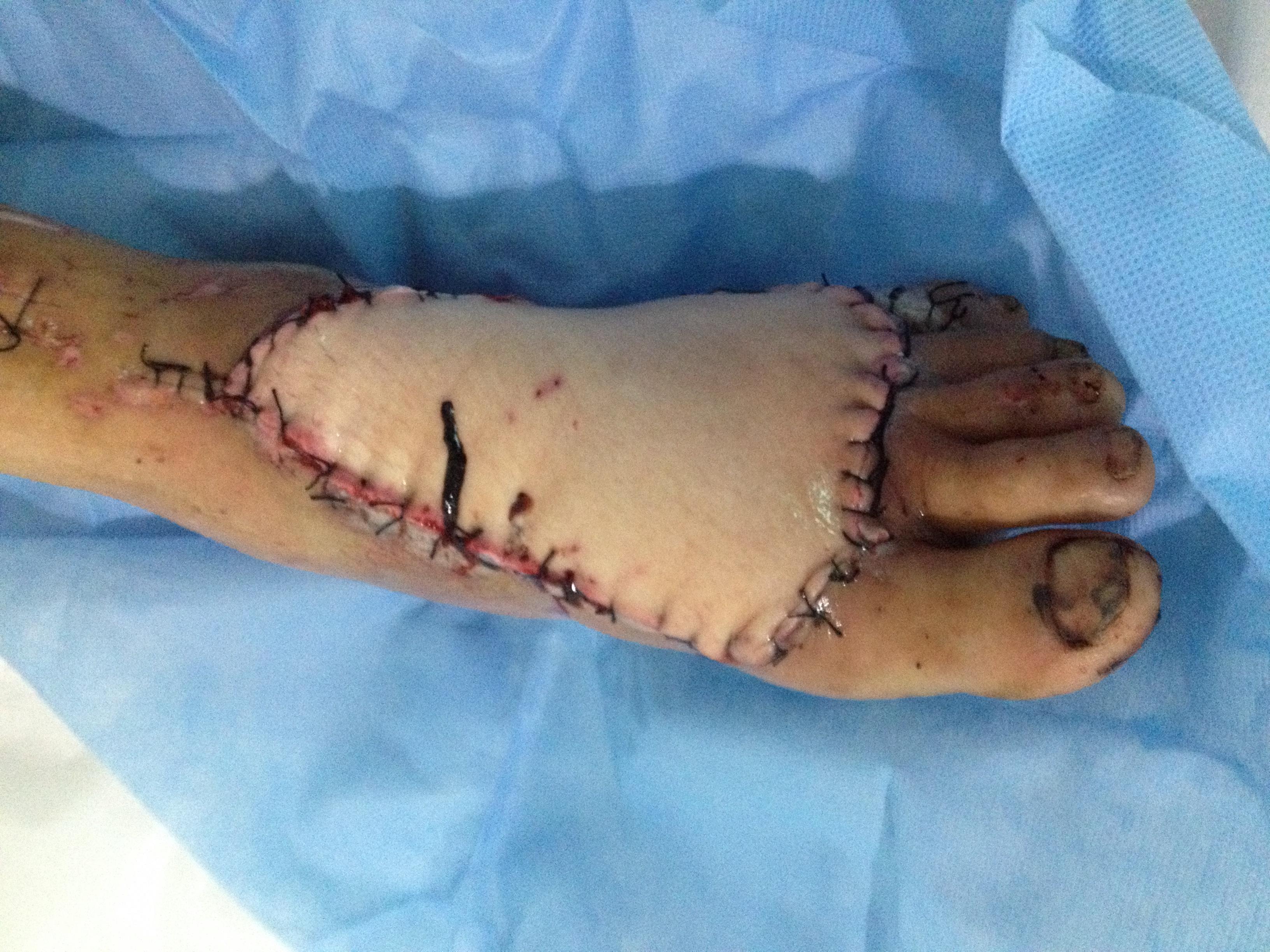 显微手足外科腹股沟皮瓣修复足背软组织缺损一例