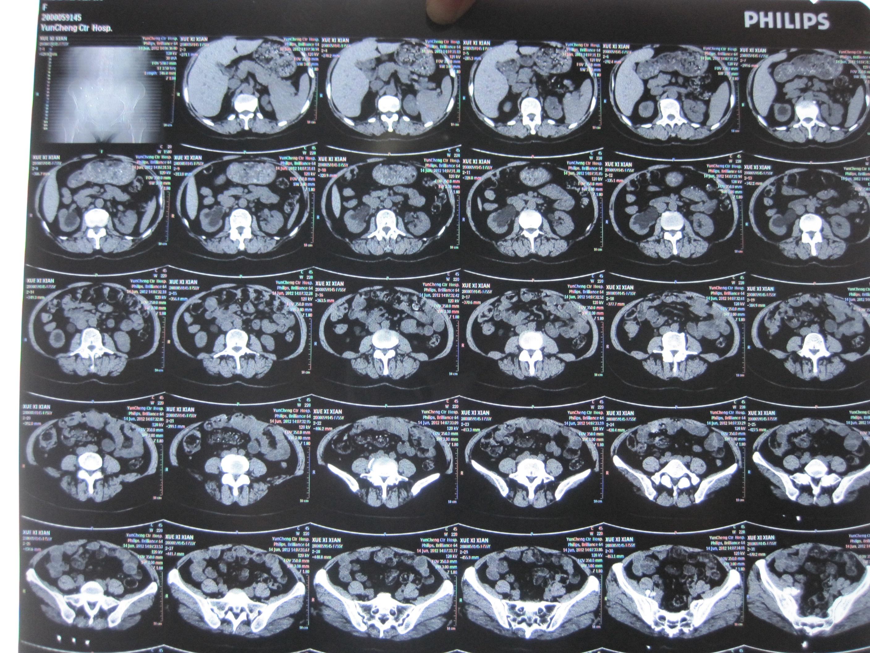 帮忙诊断一下ct和核磁片子谢谢大家了