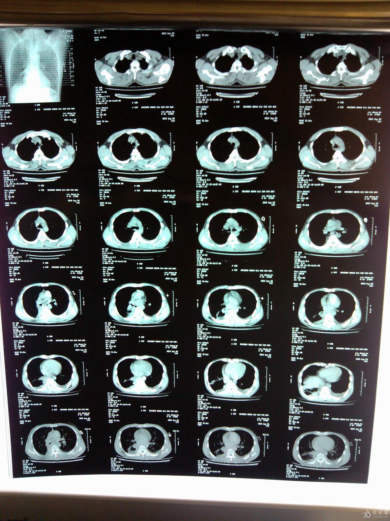 胸腔积液x线图片