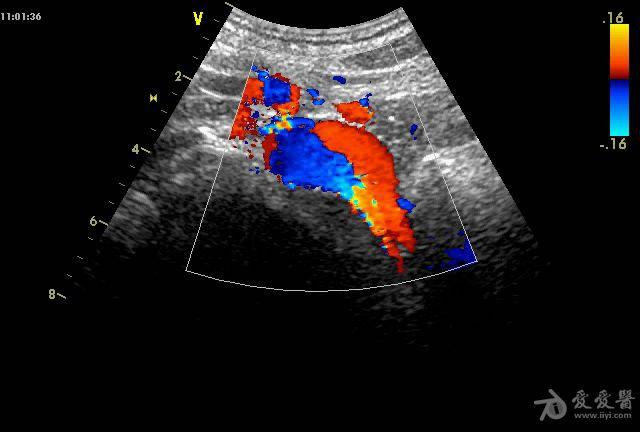 胡桃夹综合征超声图片