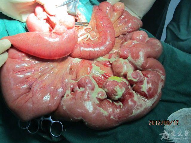 小肠多发憩室术中照片
