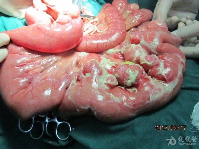 小肠多发憩室术中照片