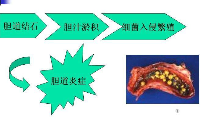 专科护理知识培训第7期胆石症和胆道感染的护理
