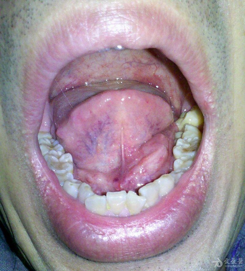 舌下腺发炎的图片图片