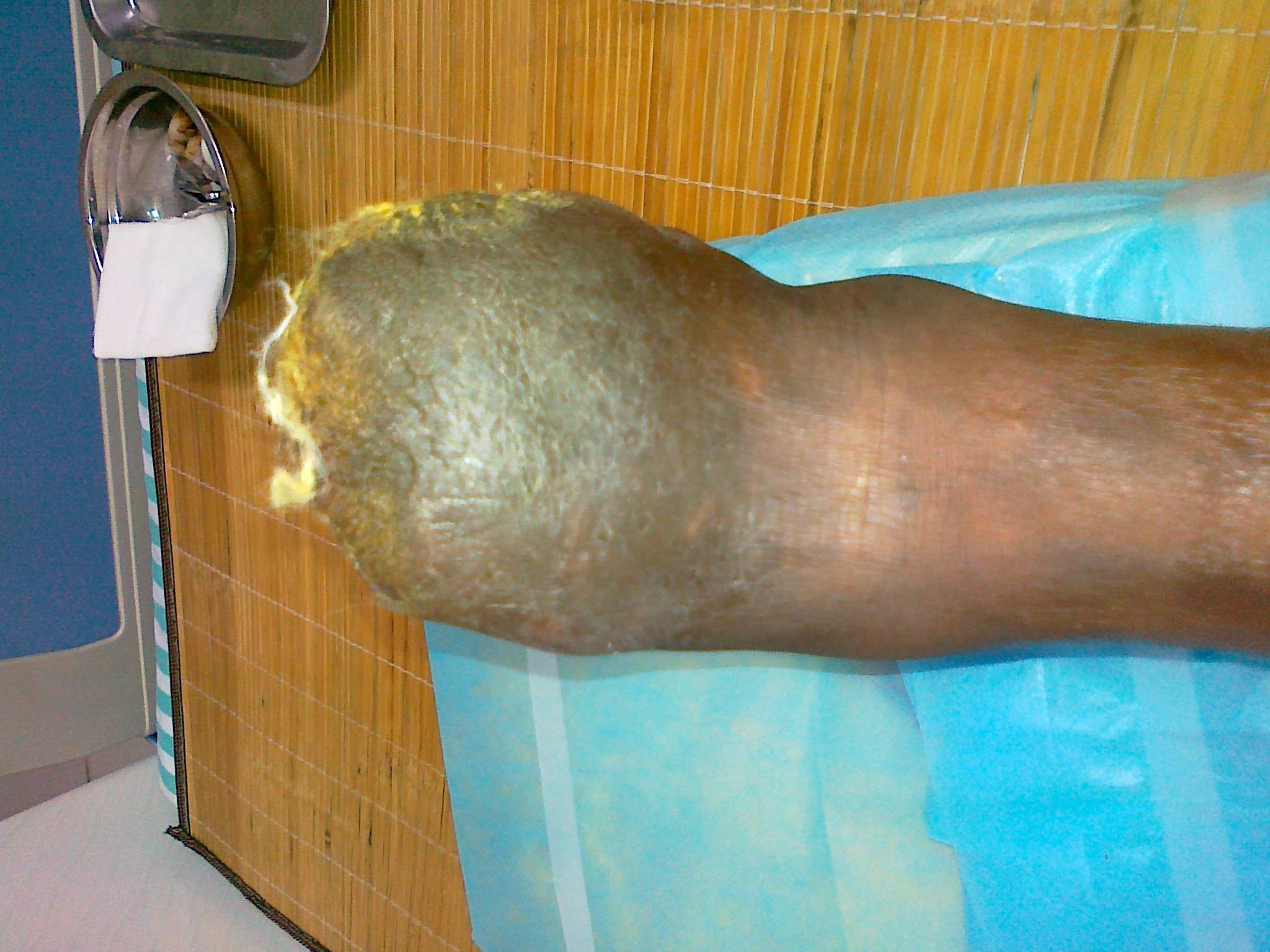 这个脚是什么问题