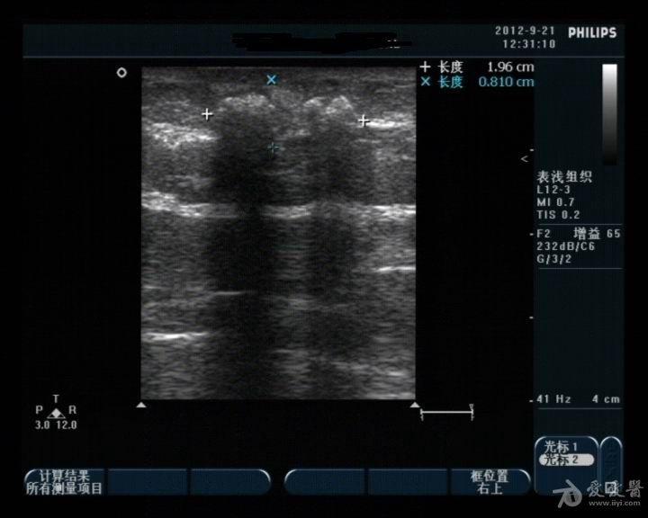 是骨化性肌炎吗 - 超声医学讨论版 - 爱爱医医学论坛