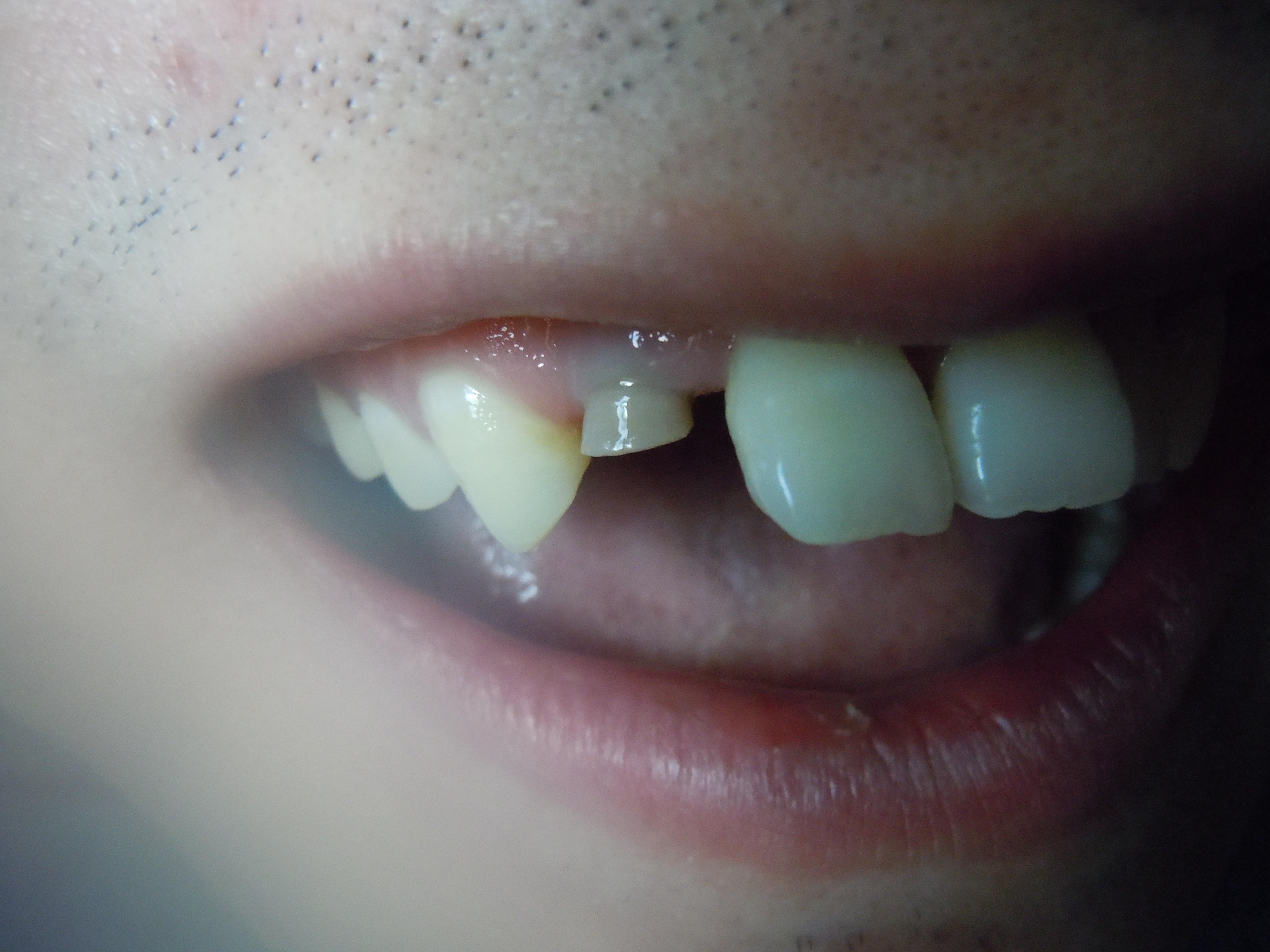 右上侧切牙断裂求修补方法