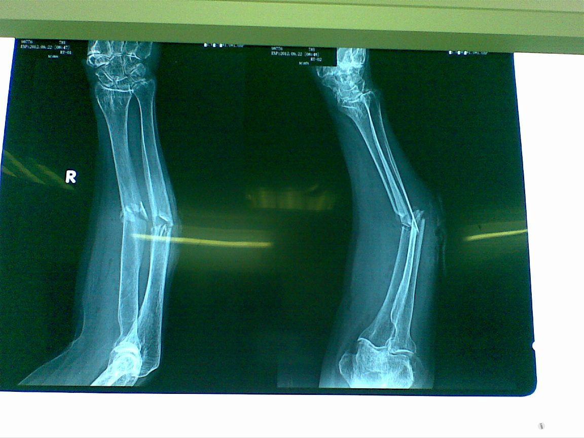 前臂中段开放性双骨折