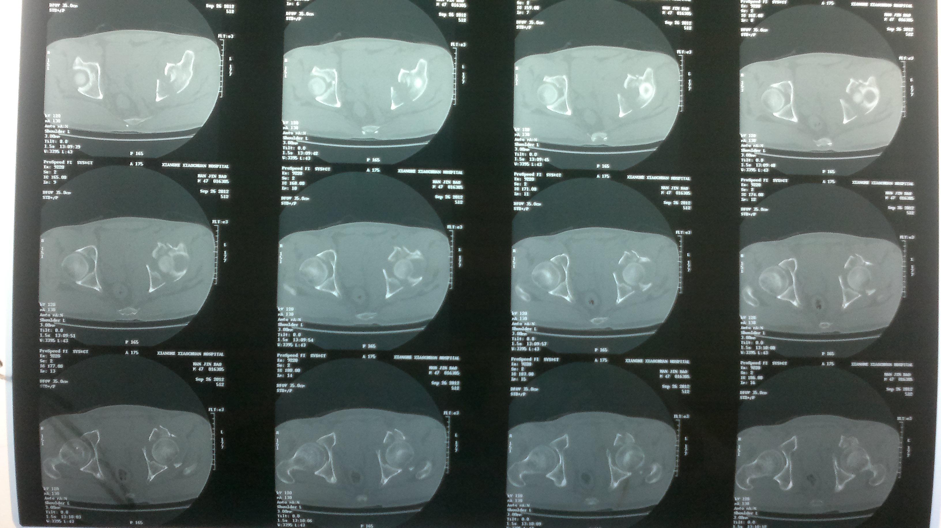 髋关节中心性脱位