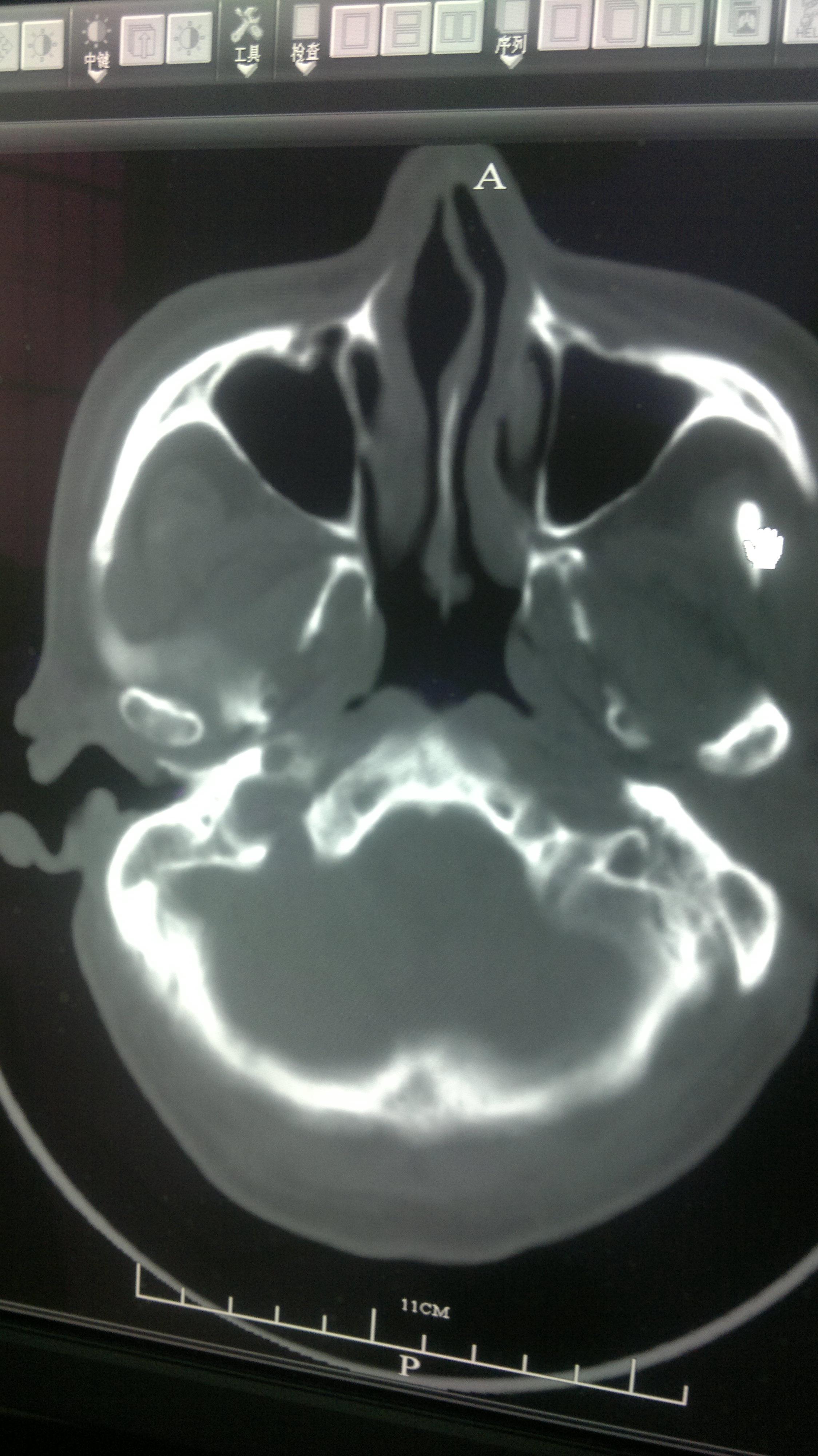 额骨骨瘤ct图片图片