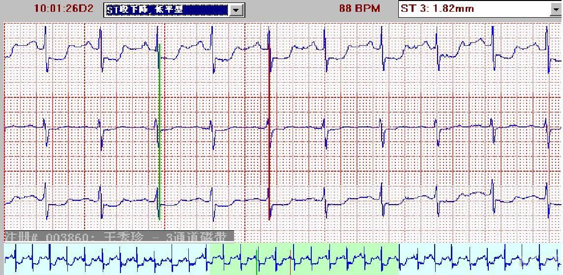 动态心电图出现心绞痛是心电图jpg
