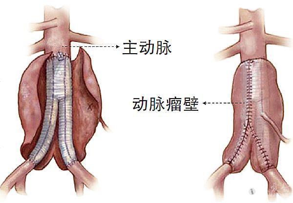 警惕腹中要命的腹主動脈瘤