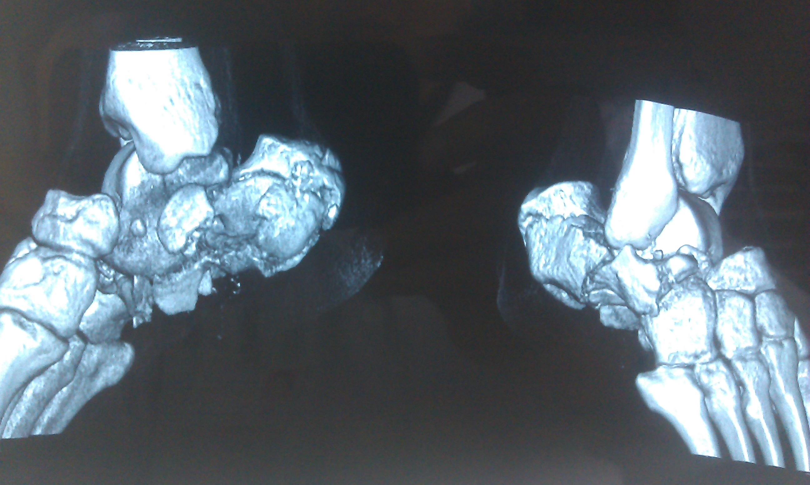 坠落伤多发伤多处骨折