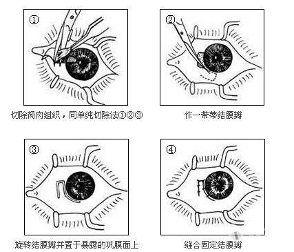 翼状胬肉的手术治疗图谱