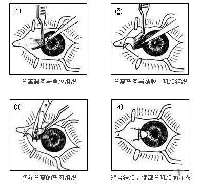 翼状胬肉 部位图片