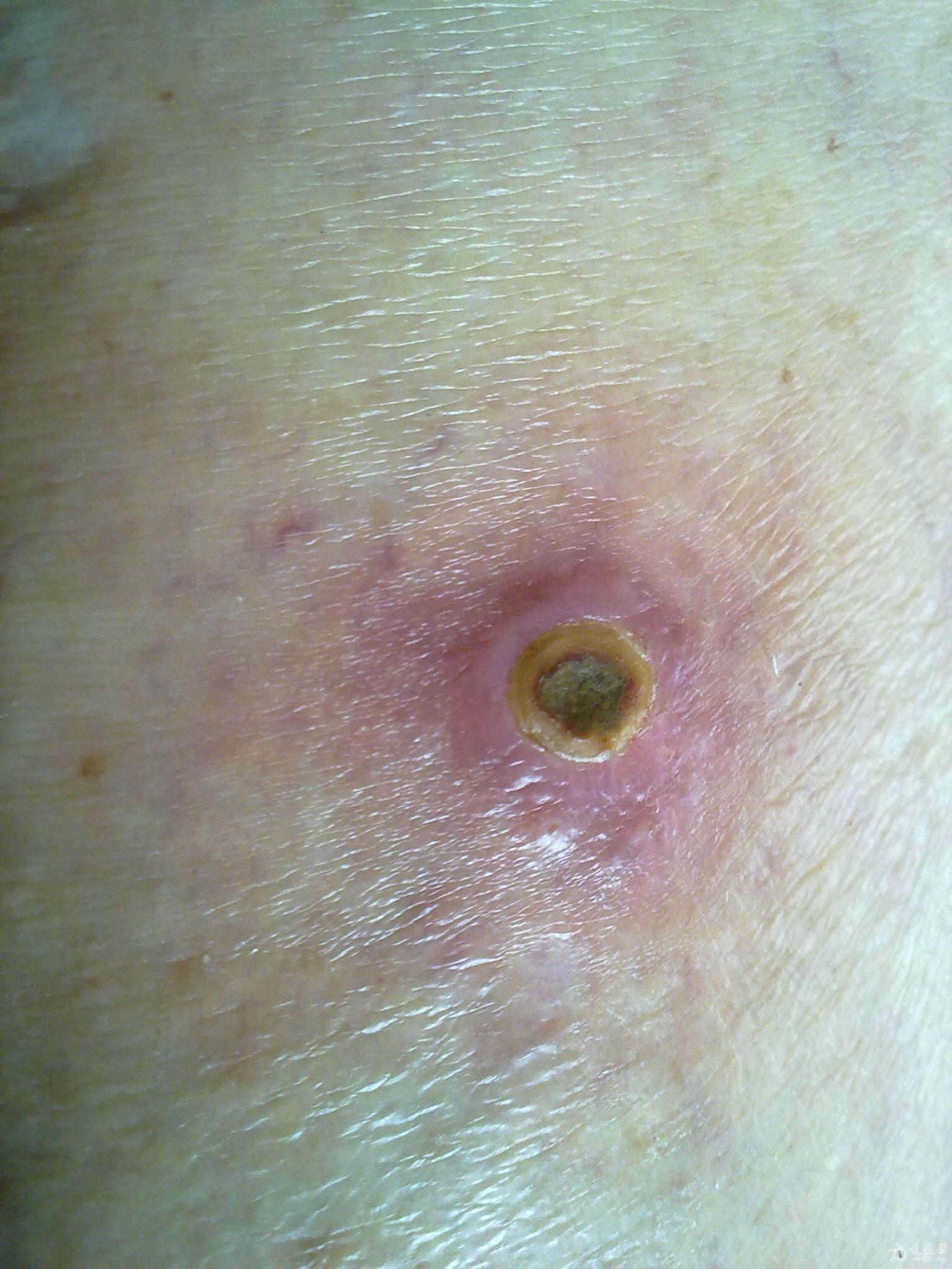 顽固瘙痒两月余,至今还不知是何病,请高手看图指教 - 皮肤及性传播