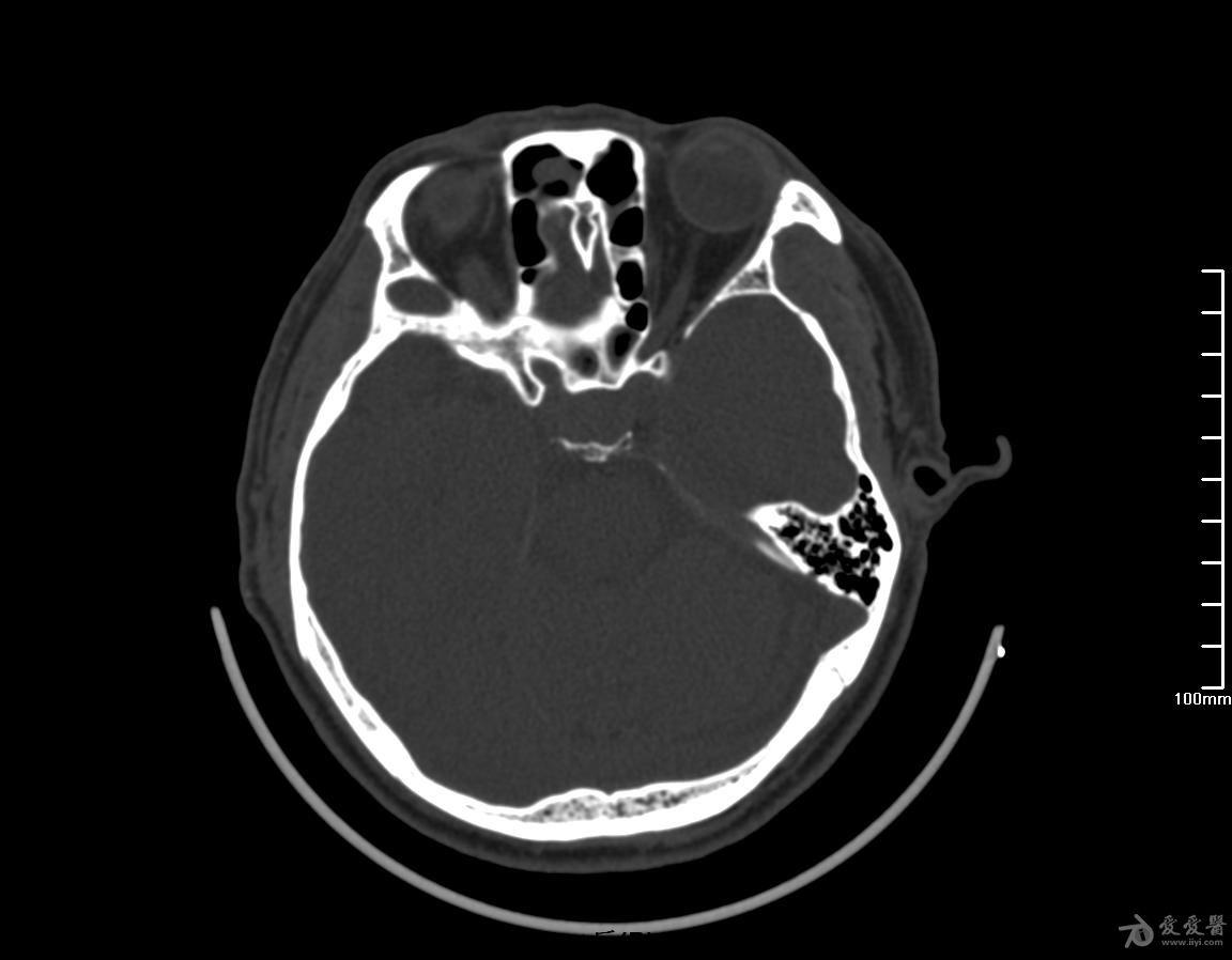 蝶鞍部占位穿刺术后复查