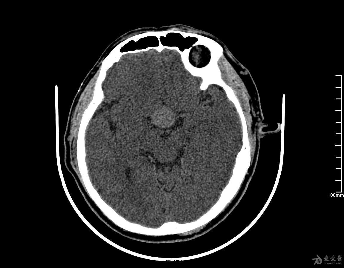 蝶鞍部占位穿刺术后复查