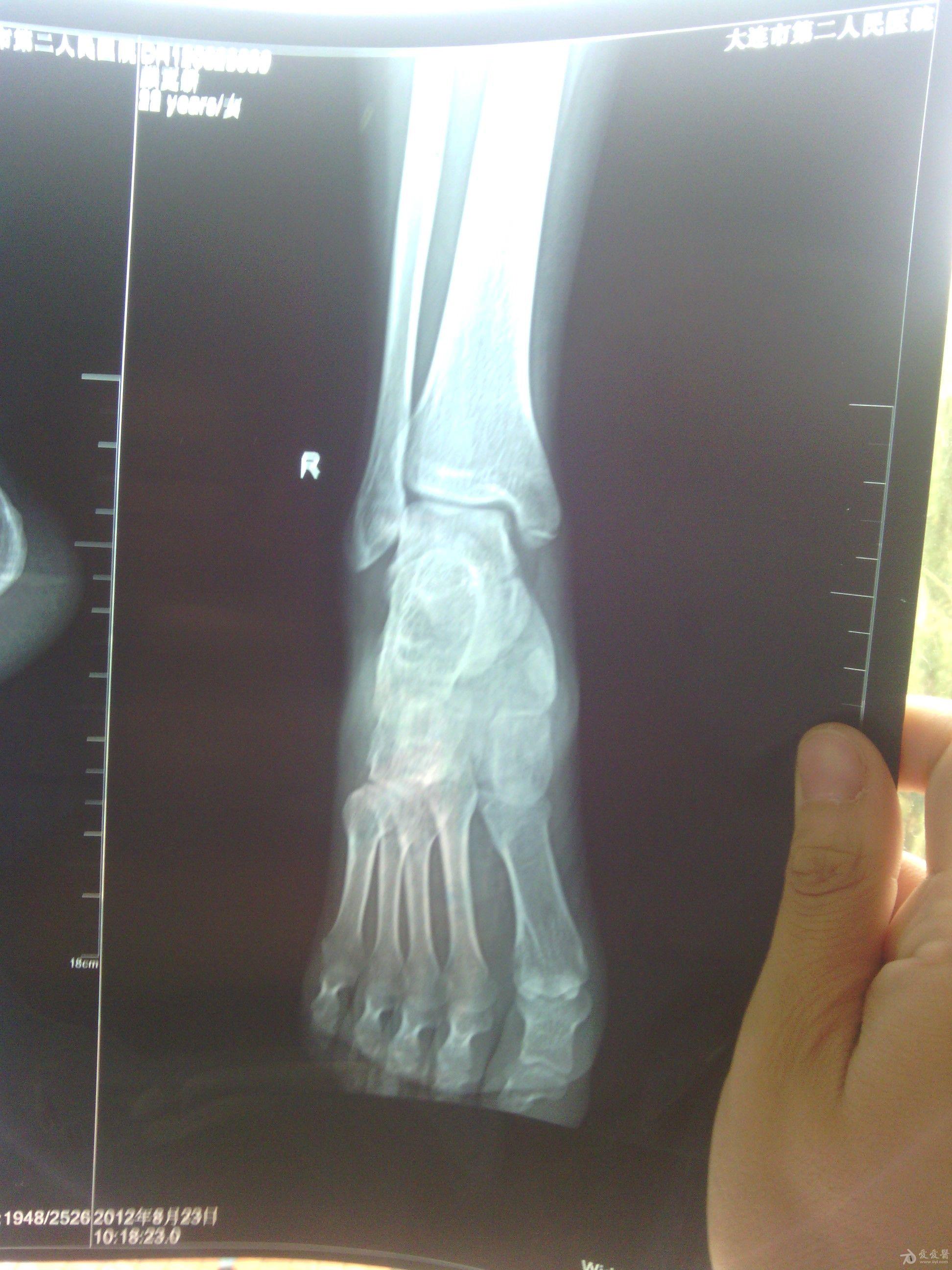 右脚内踝骨折图片图片