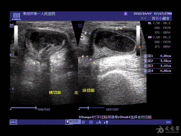 股疝嵌顿体表超声图