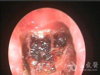 鼻咽镜鼻咽癌图片图片