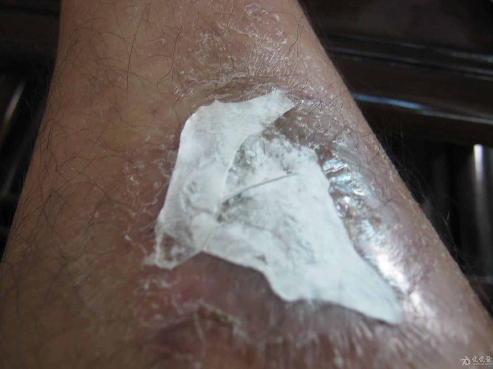 凤凰衣治疗皮肤溃疡效果杠杠的