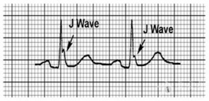 洪葵:j波和epsilon波的识别和临床意义
