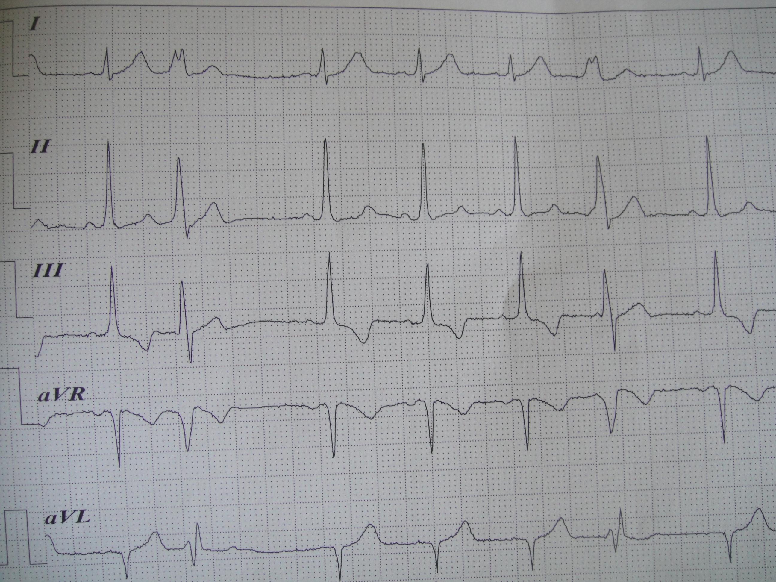 请问这是室早呢还是房早并差传两者如何鉴别