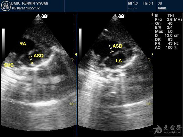 小儿房间隔缺损中央型