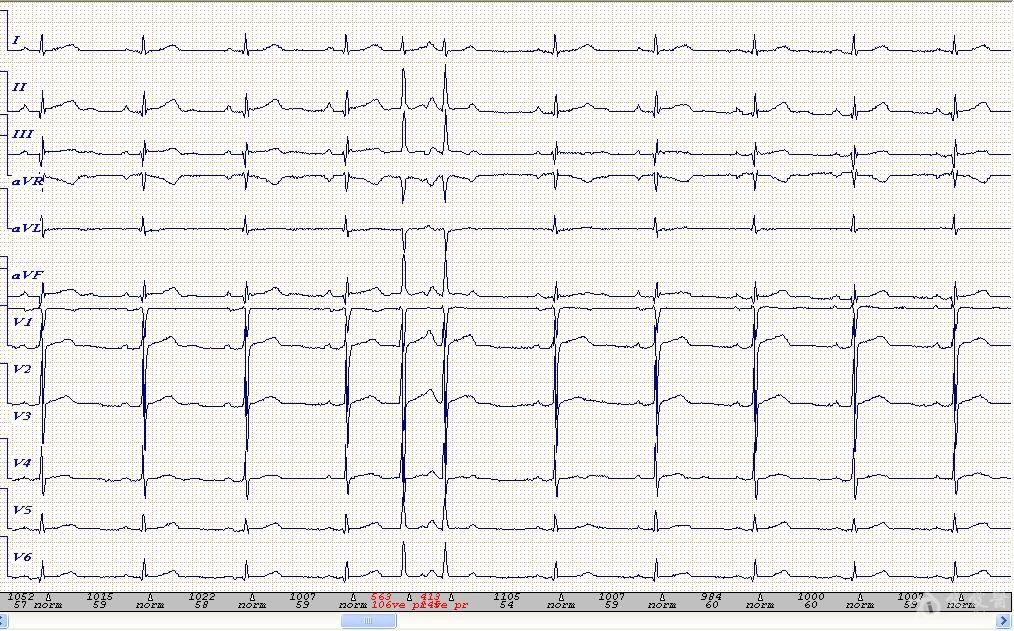 交接性早搏伴差传高位室早